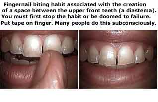Habits, finger in mouth, thumb sucking, pen pencil chewing, fingernail biting, oral diastema, gaps