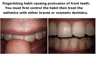 Habits, thumb sucking in mouth, pen pencil chewing, fingernail biting teeth space gaps tooth