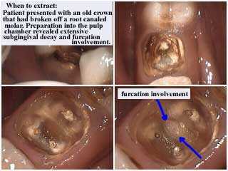 furcation involvement subgingival decay tooth cavity below the gum caries teeth recession receded 