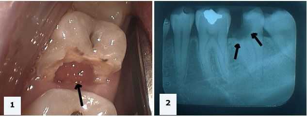 Hopeless tooth teeth extraction periodontal gum abscess decay cavity caries