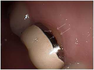 hot cold percussion sensitivity teeth sensitive tooth pain gum recession chronic acute