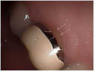 gingival recession gum sensitivity hot cold pain sensitive gums toothbrush mucogingival 