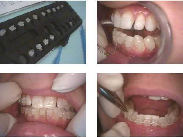 Placement of orthodontic brackets on teeth for braces.