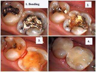 how to bonding restorations, fillings, bonding, dental, composite resin technique method