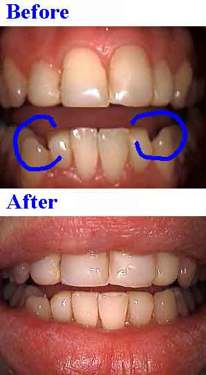 how to bonding to close spaces, cosmetic bonding for fang teeth, method explained