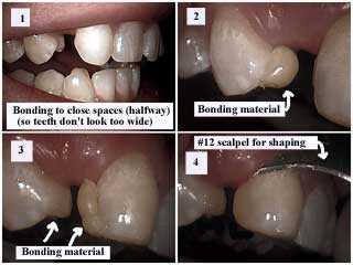 dental composite resin bonding gaps, close front tooth, dentist