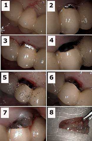 complications, problems how to, tooth root resection extraction porcelain fused metal bridge cap