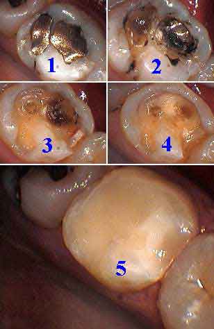 how to photos bonding, fillings, restorations, operative technique, proximal contact