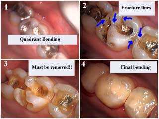 tooth decay under old silver fillings, cavity removal technique, bonded dental, bonded cosmetic