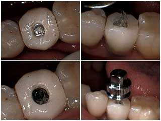 dental implants, crowns caps, access, loose second stage screw, mobility