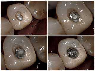 dental implants problems complications, tooth implant, loose screws dental crowns off caps mobility