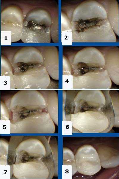 Complications in dentistry, dental diagnosis Tooth Fracture, Teeth Crack,  craze lines, dentin