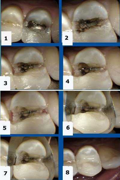 broken molar filling