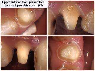 how to tooth crowns preparation ceramic all porcelain jacket PJ caps dental