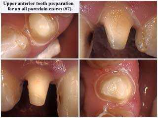 all ceramic crown preparation