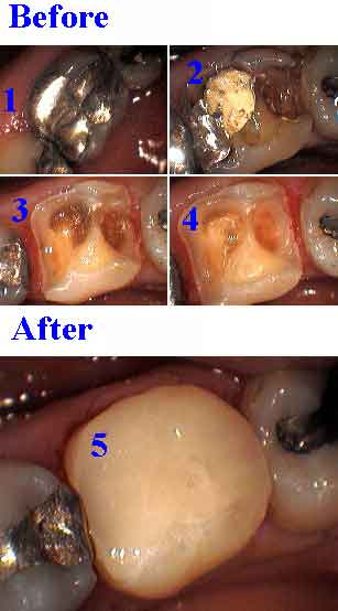 how white tooth fillings, indirect pulp cap,bonding, dental, composite resin technique