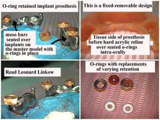 hybrid dental implants, o-ring implant prosthesis, Leonard Linkow, meso bar, fixed-removable