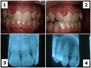 dental calculus before and after