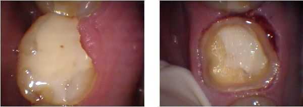 gingivectomy, gum surgery, crown preparation cap, broken cusp fracture