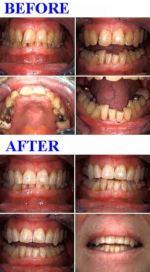 composite resin dental teeth bonding for tooth length, short teeth, cosmetic dentistry