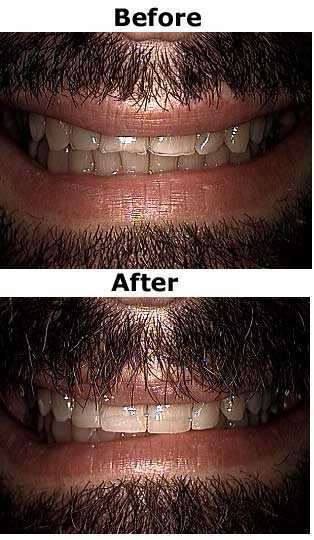 aesthetic dentistry Increasing tooth Length for Short teeth, esthetics, esthetic dentistry, dental bonding