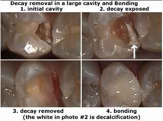 how to, Decay removal, bonding, drilling filling, restoration, cavity, decalcification