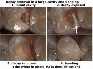 dental decay bonding tooth filling restoration cavity teeth decalcification oral mouth