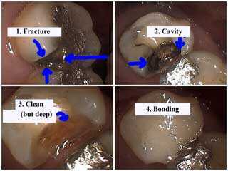 how to, fractured silver amalgam filling, diagnosis, treatment cracks cracked, composite resin