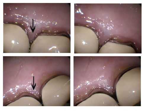 inflamed gingival margin, gum inflammation, dental tooth crown gums, gumline