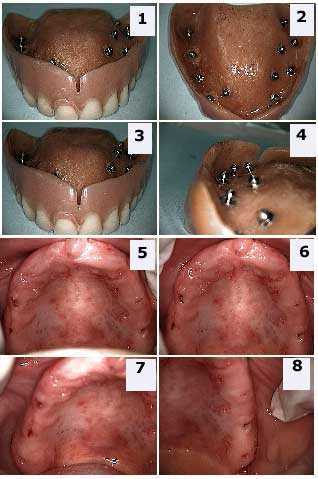 Attachments, dental Intramucosal  Implants, titanium maxillary  Implants, Snapinserts