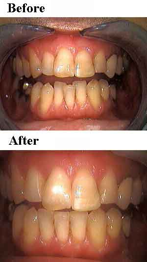 invisalign orthodontics, removable braces, orthodontistry