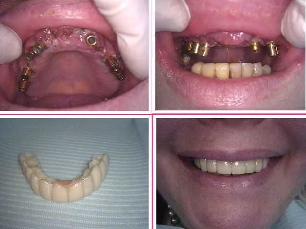 maxillary upper jaw dental implants teeth crown provisional temporary dental bridge how to photos