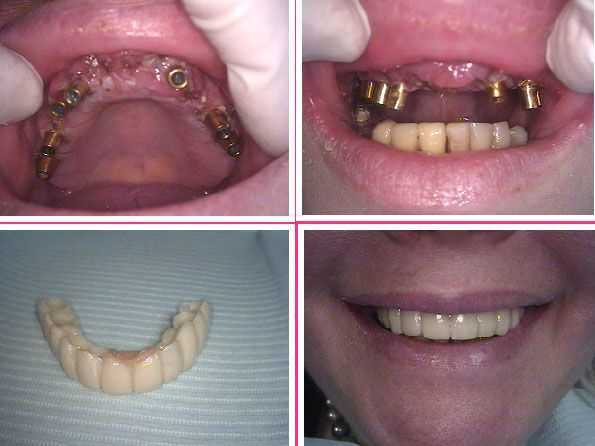 Dental Implant Bridge Before After