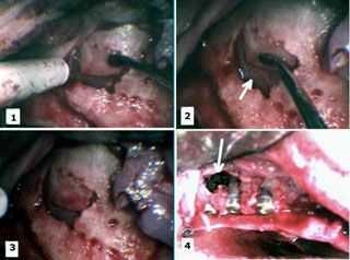 bone grafts platelet-rich plasma PRP dental implants implant oral surgery Schneiderian membrane