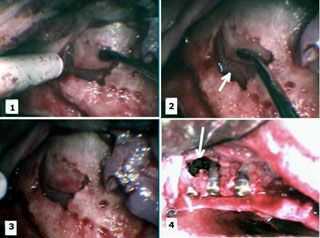 jaw evaluation, alveolar ridge, cortical bone plate, sinus elevation surgery, platelet-rich plasma