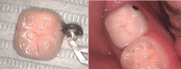 Kaitlyn Loop, porcelain dental crown, tooth cap, aspiration, swallowing, swallowed