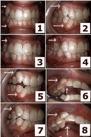 crowded crooked teeth bite dental Intercuspation intercuspal position occlusion 