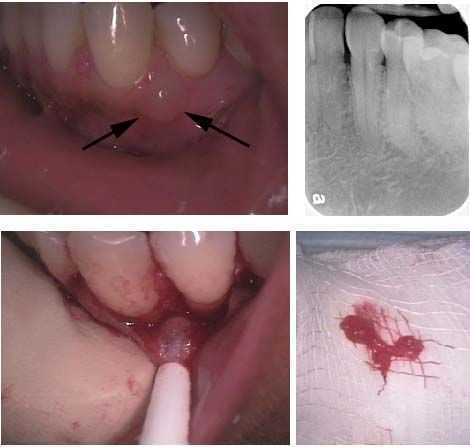 Lateral Periodontal Cyst Diagnosis  Excision  removal, Oral Pathology, dental medicine symptoms