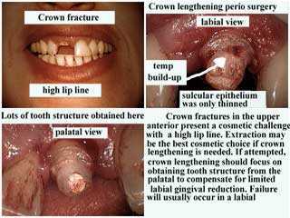 crown lengthening periodontal gum surgery, high lip line, osseous reduction, periodontist specialist
