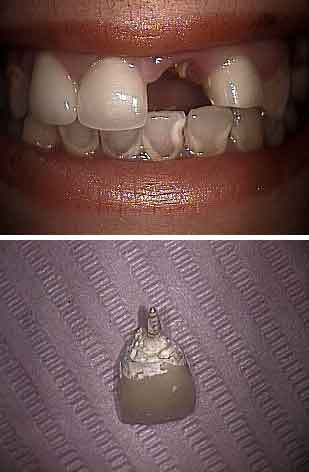 emergency front tooth fracture broken cracked teeth cap broken dental crown central incisor