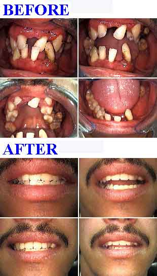 Loose tooth mobile teeth mobility fear fremitus moving severe periodontal gum disease