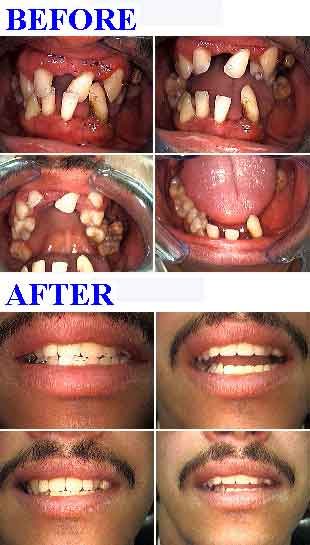 Dental Treatment For Loose Teeth