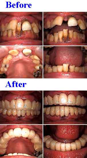 Temporary Dental Crowns Provisional Bridge, lab-processed acrylic teeth fear smile makeover