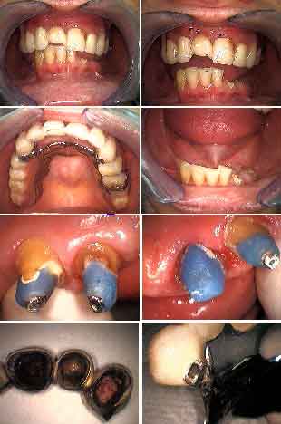 malocclusion, occlusion, bite disharmony, tooth teeth misalignment retruded contact 