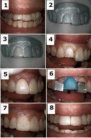porcelain teeth dental veneers tooth laminates how to technique method step by step pictures