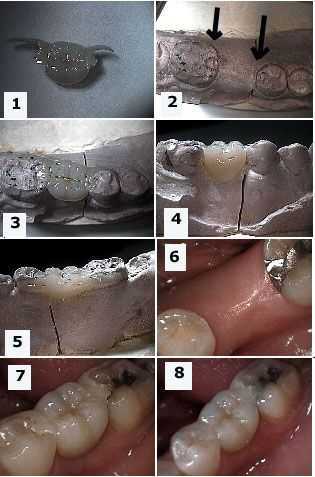 space closure, fix tooth gaps, close teeth spaces, Maryland bridge, Cristobal, Kristobal,