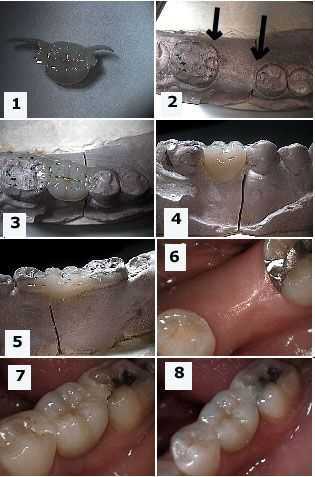 Master Models in dentistry, stone dental casts, Maryland bridge, how to pictures, working dies