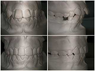 movement Orthodontic theory how teeth braces dental how to explain orthodontist explanation 