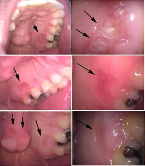 Necrotizing Sialometaplasia, Kenalog in Orabase, oral  pathology lesions symptoms treatment medicine