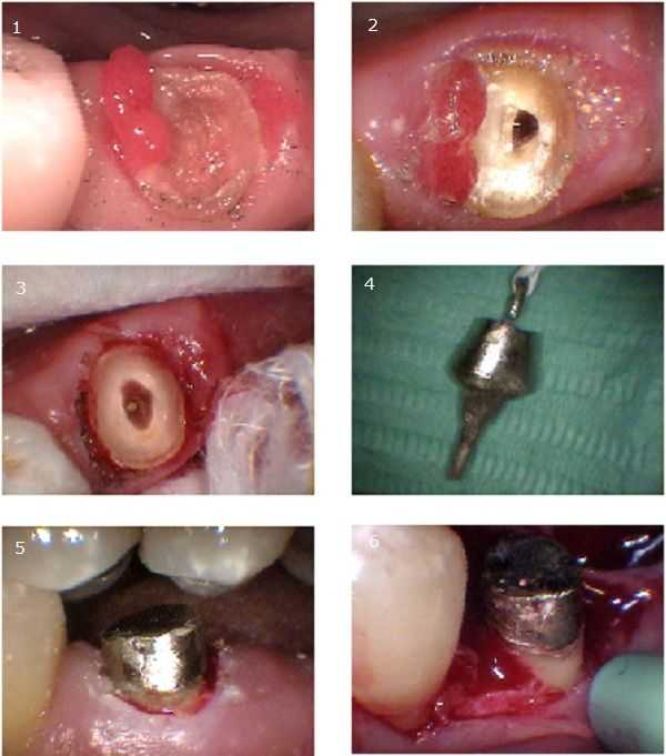 need for cast post and core, how to, periodontal surgery, cavity below gum, tooth decay gumline